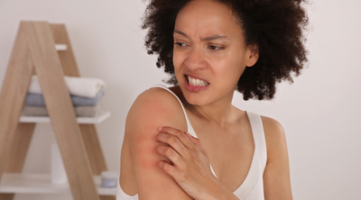 Eczema & Psoriasis | Natural Hydration Skincare